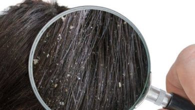 Photo of सर्दियों में शुरू होने लगी हैं बालों में डैंड्रफ की समस्या तो ऐसे पाए इससे निजात
